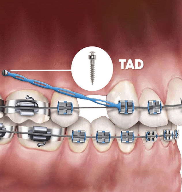 Orthodontist Gum Surgery At Danelle Perez Blog